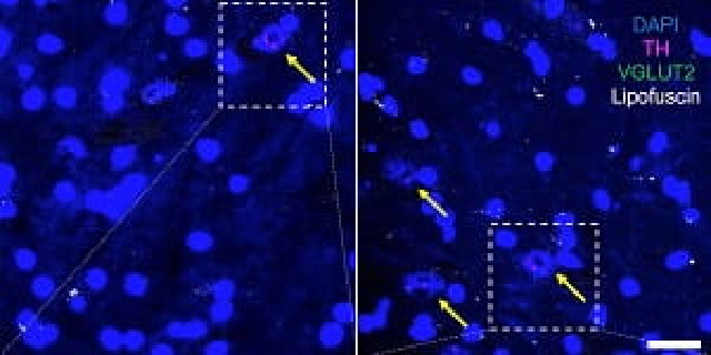 Protein Linked to Sex Differences in Age-Related Neuron Loss